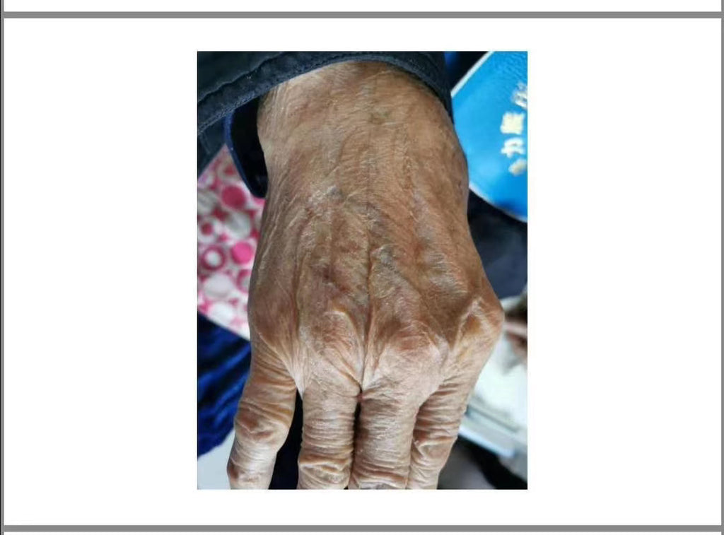 Case Sharing: How to treat the swelling and solution of hands which cause by Gout
